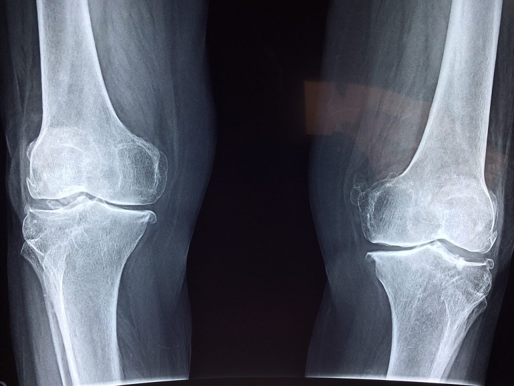 Diamo un Calcio all’Osteoporosi!