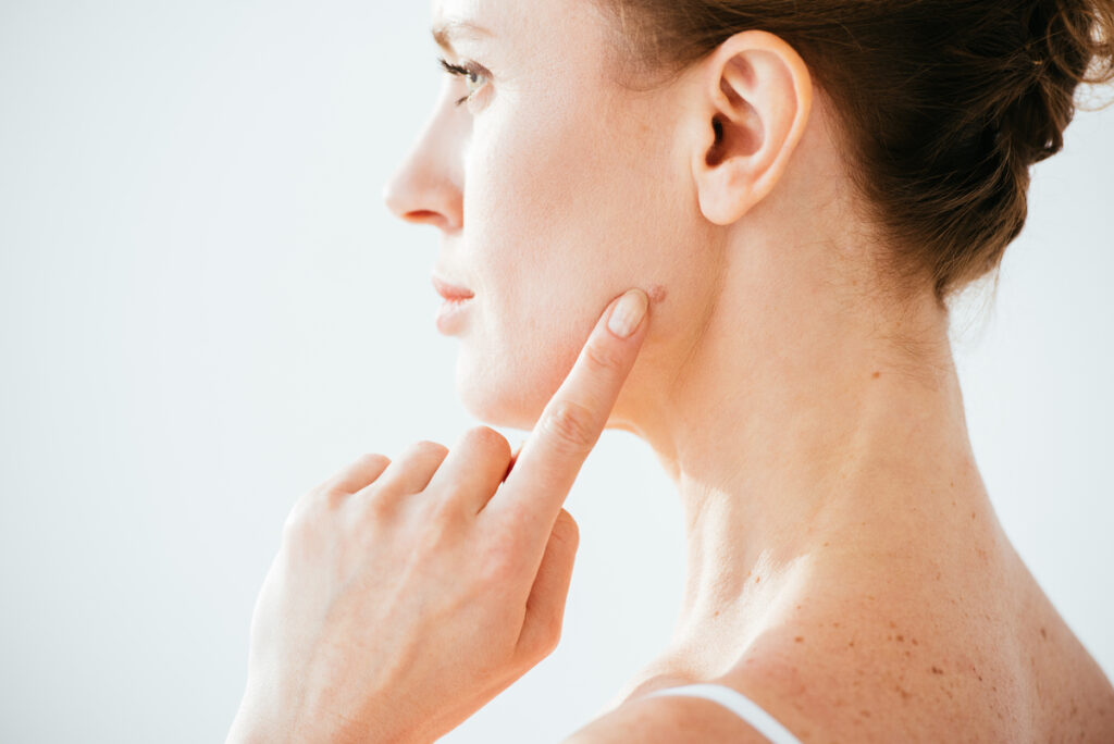 Arriva l’estate: cosa sapere per prevenire le macchie solari